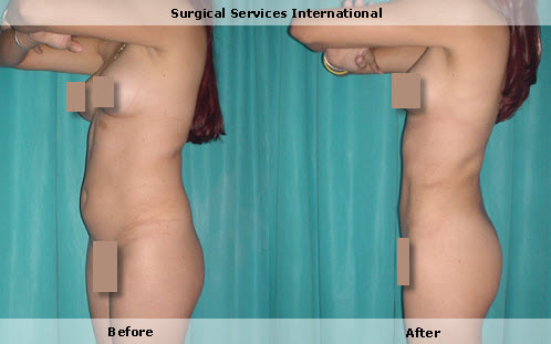 Liposuction, full body contouring